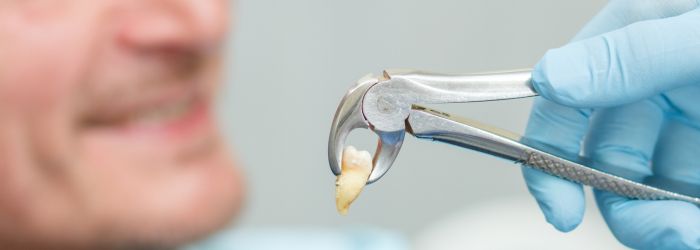 Extração dentária