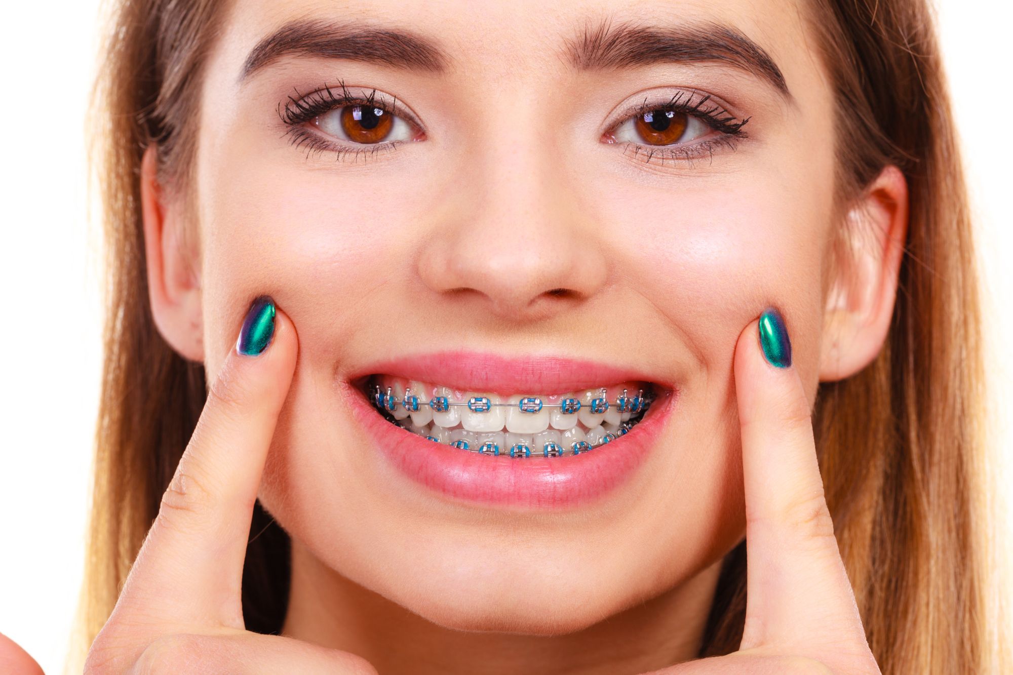 Menina sorrindo usando aparelhos dentários